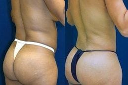 Buttock Lift Clinic in Dubai UAE 4 buttock-lift Clinic in Dubai
