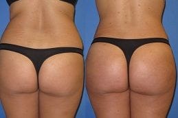 Buttock Lift Clinic in Dubai UAE 5 buttock-lift in Abu Dhabi