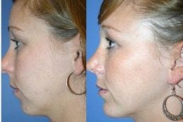 chin-augmentation Clinic in Dubai