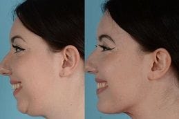 Chin Augmentation 9 chin-augmentation in dubai