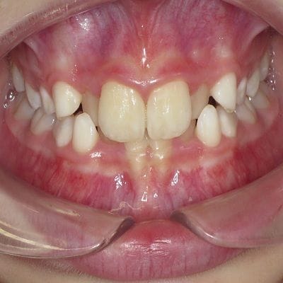 Crowded Teeth Treatment Cost in Dubai 1 crowded teeth treatment in dubai