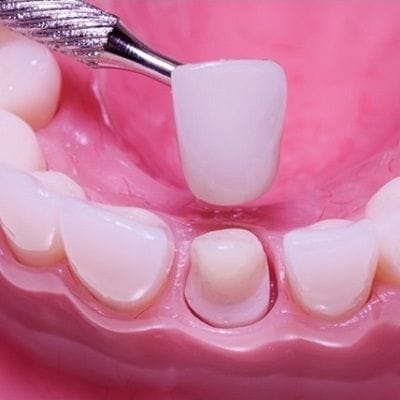 Dental Crown Cost in Dubai 1 dental crown cost dubai