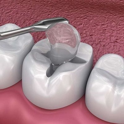 Top 10 Facts You Must Know About a Dental Filling 1 dental fillings in dubai
