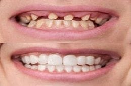 Dental Implant With Crown Package At 999 AED 1 dental implants in dubai