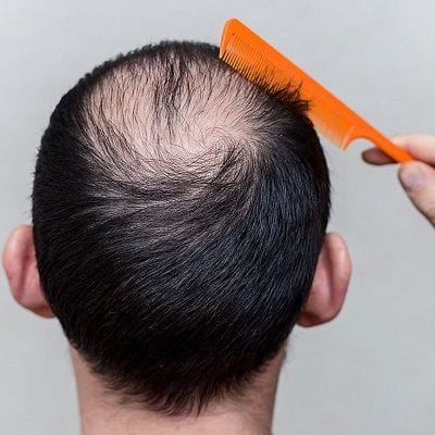 genetic hair loss