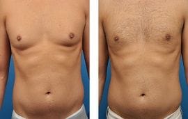 Best Breast Reduction Clinic Dubai 12 gynaecomastia surgery in dubai-before and after