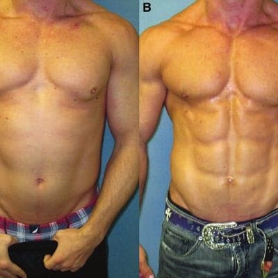 gynecomastia surgery in dubai