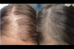 Hair Loss & Nail Disorders Treatment 4 hair-loss-nail-disorders-treatment Clinic in Dubai