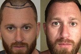 FUT & FUE Hair Transplant Al Ain 1 hair-transplant-al-ain Clinic in Dubai