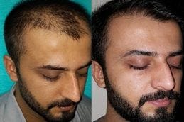 Hair Transplant in Ajman & Fujairah before and after