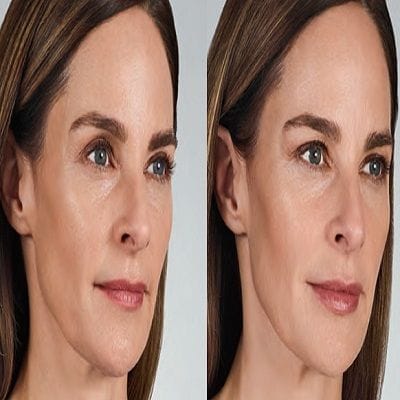 How Long To See Results From Volbella Fillers