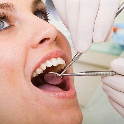 how long tooth filling last in Dubai