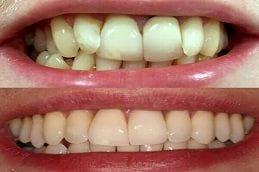 Invisalign Braces 5 Before & After Invisalign Braces