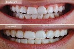 Invisalign Braces 6 Before & After Invisalign Braces Dubai