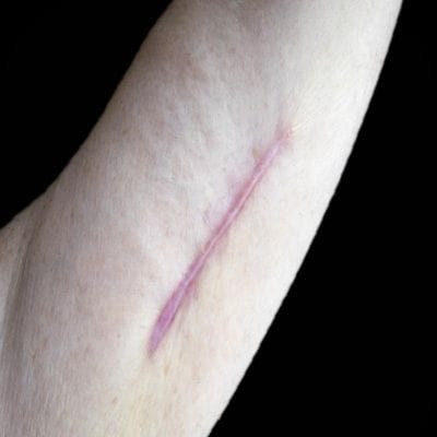 Permanent keloid removal | Procedure & Cost