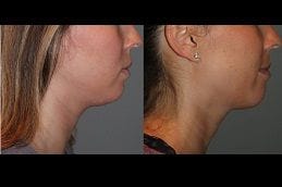 kybella-treatment-for-double-chin in Abu Dhabi