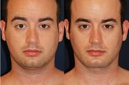 kybella-treatment-for-double-chin in dubai