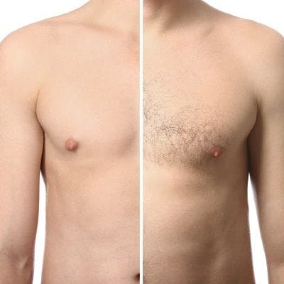 5 Facts About Chest Hair Removal Through Laser Treatment 1 5 Facts About Chest Hair Removal Through Laser Treatment
