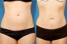 Lipo Abdominoplasty 6 lipo-abdominoplasty in Abu Dhabi