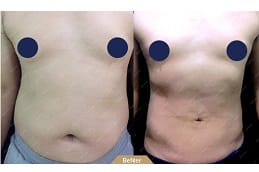 lipomatic-treatment Clinic in Dubai