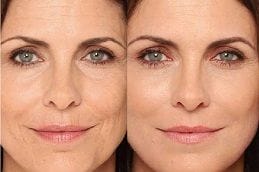 liquid-facelift in dubai