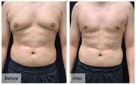 Best Breast Reduction Clinic Dubai 11 male breast Reduction surgery before & after