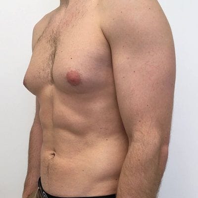 Gynecomastia in Dubai