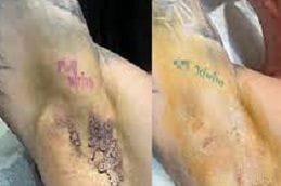Miradry Treatment 4 miradry-treatment in Abu Dhabi