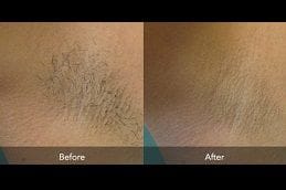 non-invasive-hair-removal Clinic in Dubai