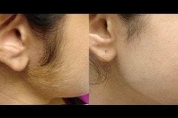 Non-Invasive Hair Removal 9 non-invasive-hair-removal in Abu Dhabi