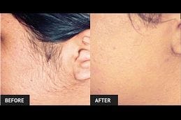 non-invasive-hair-removal in dubai
