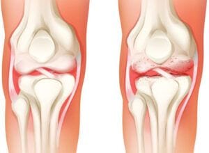 prp for knee