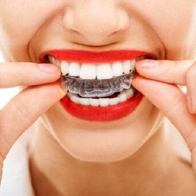 Teeth Retainer In Dubai: Their Types And Cost 1 Teeth retainer cost in dubai