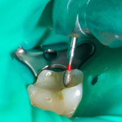 root canal treatment