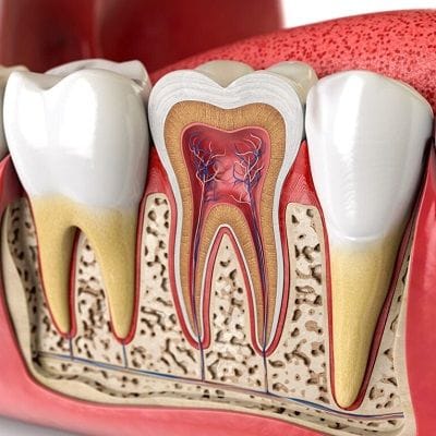 root canal treatment dubai