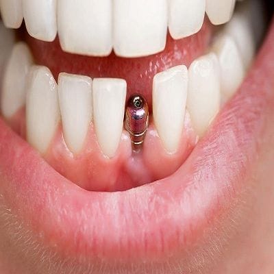 What Are Same Day Dental Implants And Are They Right For You?