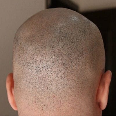 scarless hair transplant in Dubai & Abu Dhabi