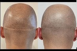 Scarless Hair Transplant 5 scarless-hair-transplant in dubai
