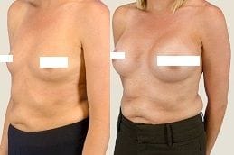 Short Scar Breast Augmentation 6 short-scar-breast-augmentation in Abu Dhabi