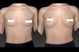 Short Scar Breast Augmentation 5 short-scar-breast-augmentation in dubai