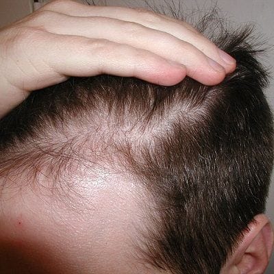 Side Effects of Non-Surgical Hair Replacement 1 side effects of non surgical hair replacement Dubai & Abu Dhabi