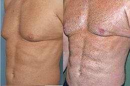 Six Pack Abs Surgery 4 six-pack-abs-surgery Clinic in Dubai