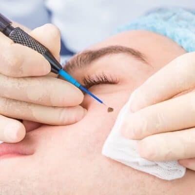How Much Does It Cost To Get A Lesion Removed In Dubai? 1 Skin-Lesion-Removal