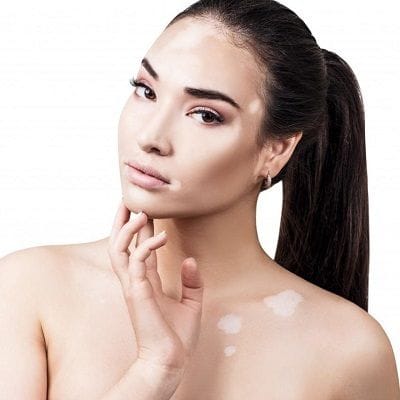 How Skin Whitening Treatments Can Help Vitiligo Patients