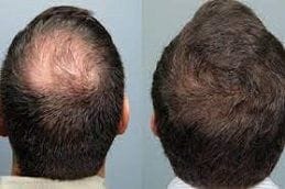 Stem Cell Hair Transplant 4 stem cell hair transplant in dubai