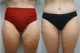 Thigh Lift Thighplasty 4 thighplasty-thigh-lift in Abu Dhabi