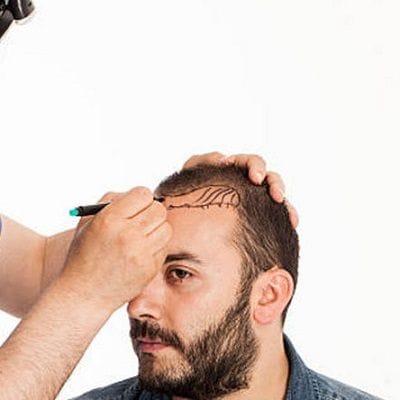 How Long Do I Have To Wait To Travel After A Hair Transplant
