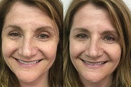 Vampire Facelift 9 vampire-facelift Clinic in Dubai