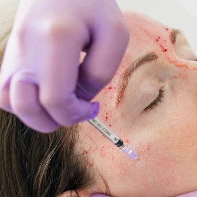 Vampire Facelift vs Vampire Facial 1 Vampire Facelift vs Vampire Facial