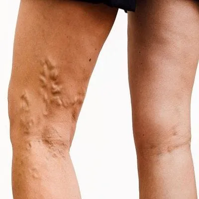 Varicose Veins: Causes, Symptoms and Treatment